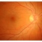 Diabetická retinopatie – jedna z nejčastějších komplikací diabetu